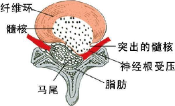 腰间盘突出最新疗法，科技与医学进步的结合力量探索